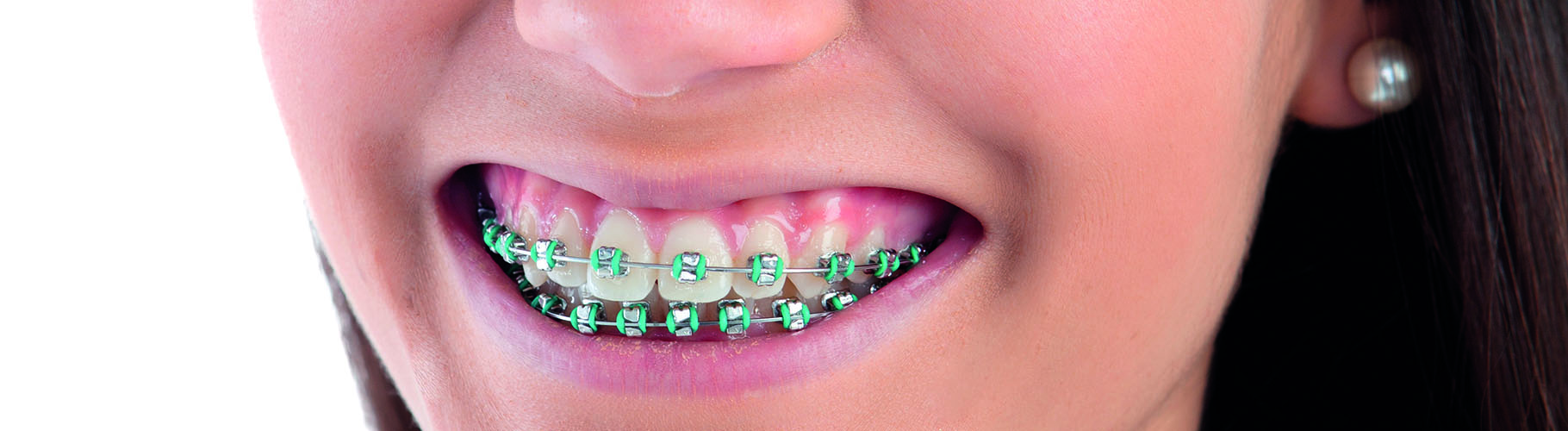 Ortodontia/Aparelho Fixo